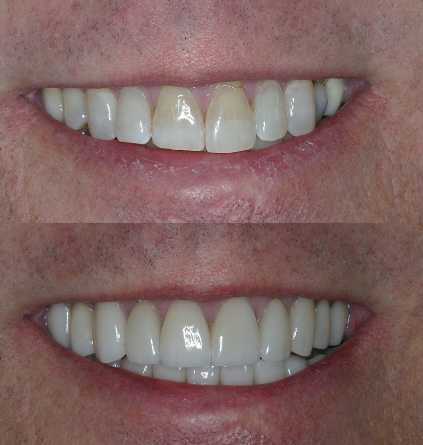Before &amp; After Porcelain Crowns Cosmetic Dentists of