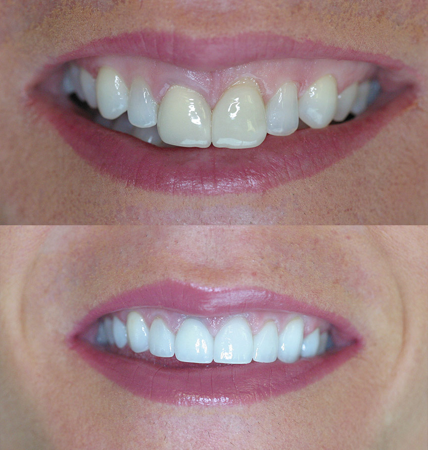 Before & After Porcelain Veneers Cosmetic Dentists of Houston Cosmetic Dentist General Dentistry