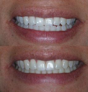 invisalign before after 3