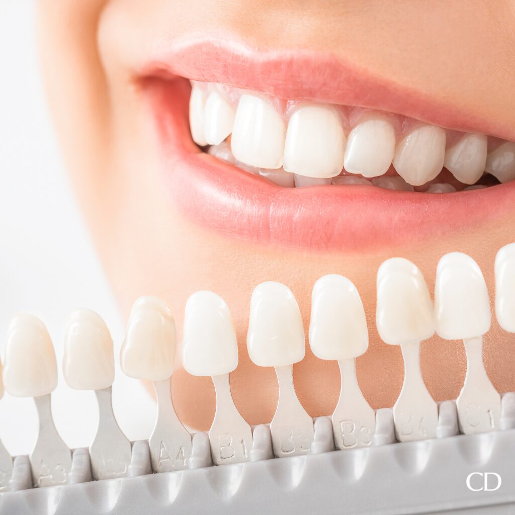 teeth whitening at cosmetic dentists of houston